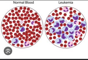 two petri dishes, one showing normal blood and the other showing blood with leukemia