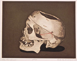 Van Hoesen skull