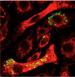 Tularemia